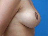 Patient # 78315 After Photo # 4