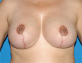 Patient # 67848 After Photo # 2