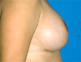 Patient # 67848 After Photo # 4