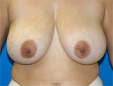 Patient # 67848 Before Photo # 1