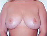 Patient # 27164 After Photo # 2