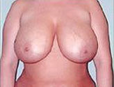 Patient # 27164 Before Photo # 1