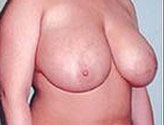 Patient # 27164 Before Photo # 3