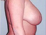 Patient # 27164 Before Photo # 5