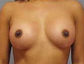 Patient # 58525 After Photo # 2