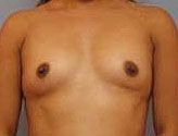 Patient # 58525 Before Photo # 1