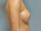 Patient # 36498 After Photo # 6