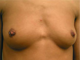 Patient # 67845 Before Photo # 1