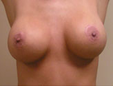 Patient # 28718 After Photo # 2