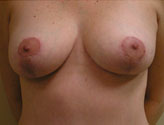 Patient # 65844 After Photo # 2