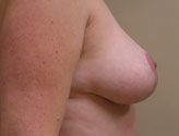 Patient # 65844 After Photo # 4