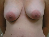 Patient # 65844 Before Photo # 1