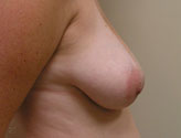 Patient # 65844 Before Photo # 3