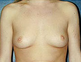 Patient # 41196 Before Photo # 1