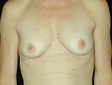 Patient # 49104 Before Photo # 1