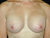 Patient # 91927 After Photo # 2