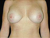 Patient # 91655 After Photo # 2