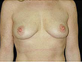 Patient # 91655 Before Photo # 1
