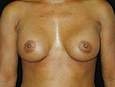 Patient # 96361 After Photo # 2