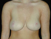 Patient # 37256 After Photo # 2