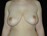 Patient # 21469 After Photo # 2