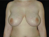Patient # 21469 Before Photo # 1
