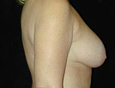 Patient # 44519 Before Photo # 1