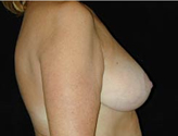 Patient # 86845 After Photo # 2