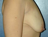 Patient # 65273 Before Photo # 3