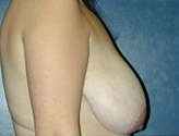 Patient # 60656 Before Photo # 1
