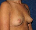 Patient # 36484 Before Photo # 3