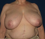 Patient # 67831 Before Photo # 1