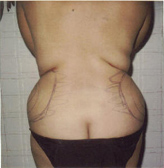 Patient # 33090 Before Photo # 1