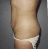 Patient # 61910 Before Photo # 1