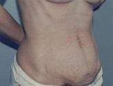 Patient # 15135 Before Photo # 3