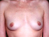 Patient # 13294 Before Photo # 1