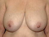 Patient # 52861 Before Photo # 1