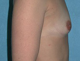 Patient # 19048 Before Photo # 5