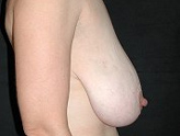 Patient # 57041 Before Photo # 3