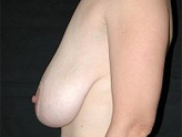 Patient # 57041 Before Photo # 7