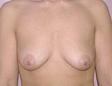 Patient # 12890 Before Photo # 1
