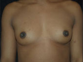 Patient # 31357 Before Photo # 1