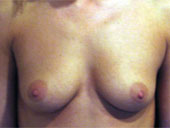 Patient # 42052 Before Photo # 1