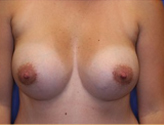 Patient # 70706 After Photo # 2