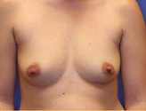 Patient # 70706 Before Photo # 1