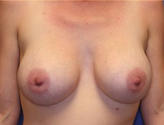 Patient # 61078 After Photo # 2