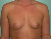 Patient # 60618 Before Photo # 1