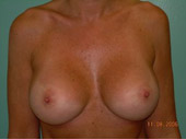 Patient # 98852 After Photo # 2