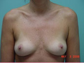Patient # 98852 Before Photo # 1
