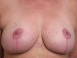 Patient # 33256 After Photo # 2
